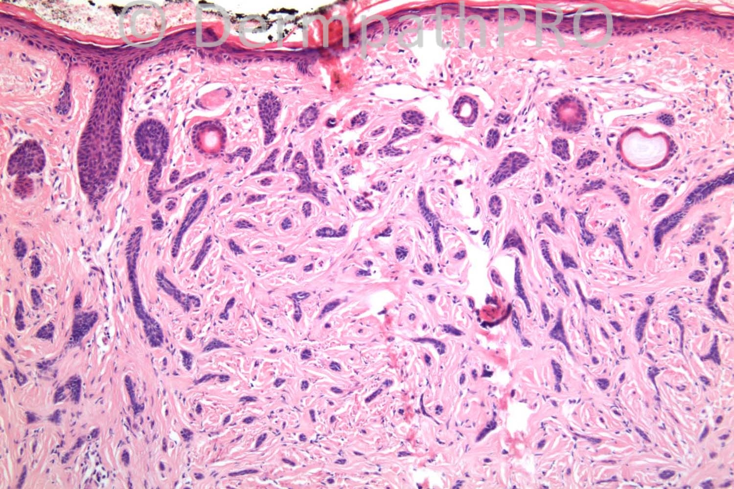 Basal-cell carcinoma - Wikipedia